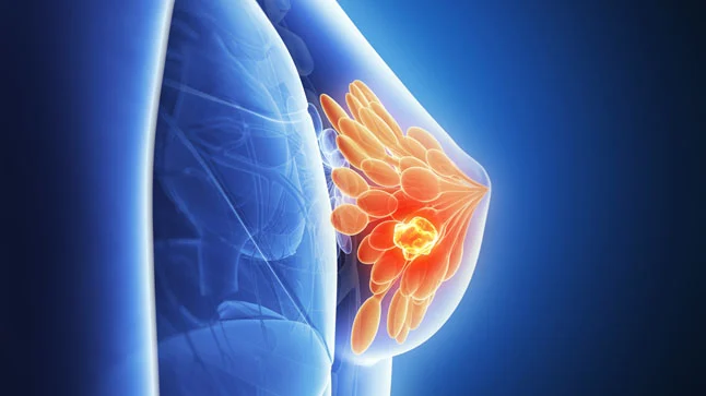 Avanza estudio para combatir cáncer de mama con nanopartículas e hidrogeles 3D de quitosano