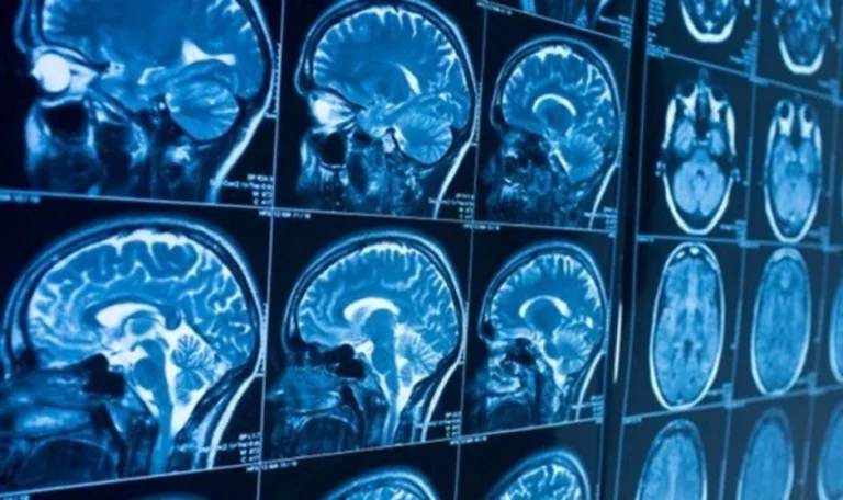 Investigadores españoles descubren neuronas defectuosas en el cerebro de pacientes con esquizofrenia